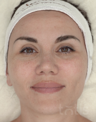 Výsledky Whitening Peel-Off Masks  фото после #2