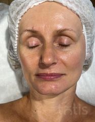 Результаты 650 Lift'Expert Wrinkle Smoother  фото после #2