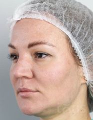 Результаты Набор TESSLIFT SOFT V-DERM (10 нитей) + Бандаж + канюля SoftFil 18G 90mm + 18G*40mm игла  фото после #2