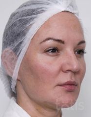 Результати Набір TESSLIFT SOFT V-DERM (10 ниток) + Бандаж + канюля SoftFil 18G 70mm + 18G*40mm голка  фото до #1