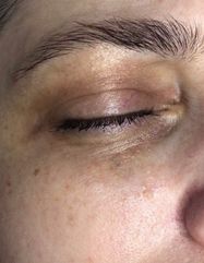 Результати EYE REVITALIZER  фото после #2