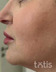 Rezultaty Zestaw TESSLIFT SOFT V-DERM (10 nici) + Bandaż + kaniula SoftFil 18G 70mm + igła 18G  фото после #2
