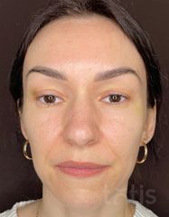 Результати Facetem S 1.5ml *1 шт. + конектор  фото до #1