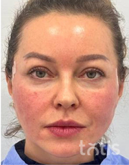 Rezultaty Zestaw TESSLIFT SOFT V-DERM (10 nici) + Bandaż + kaniula SoftFil 18G 70mm + igła 18G  фото после #2