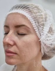 Rezultate Facetem S 0.8ml * 1 seringă  фото до #1