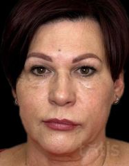 Результати Facetem S 1,5 ml  фото до #1