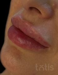 Результати Saypha Filler Lidocaine NEW  фото после #2
