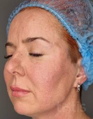 Результати Facetem S 1.5ml *1 шт. + конектор  фото после #2