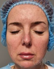 Rezultate Facetem S 0.8ml * 1 seringă  фото до #1