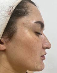 Результати 560 Lumin’Éclat Beutifying Cream  фото после #2