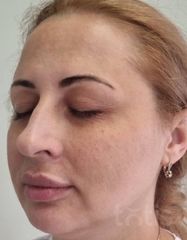 Rezultate Facetem S 0.8ml * 1 seringă  фото до #1