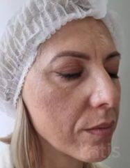 Результати Facetem S 1.5ml *1 шт. + конектор  фото до #1