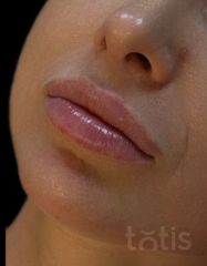 Результати Saypha Filler Lidocaine NEW  фото до #1
