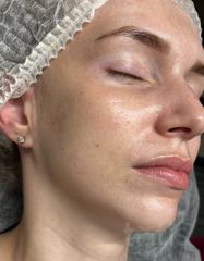 Результаты 540 Lumin’Éclat Enhancing Serum  фото до #1