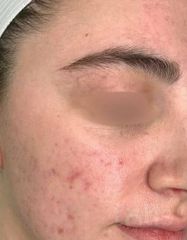 Результаты Foaming Cleanser with Amino Acids  фото после #2