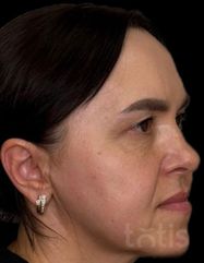 Результати Facetem S 1.5ml *1 шт. + конектор  фото после #2