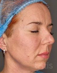Rezultate Facetem S 0.8ml * 1 seringă  фото после #2