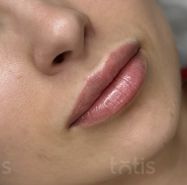 Результати Saypha lips Lidocaine  фото после #2