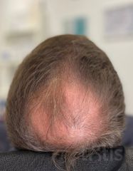 Rezultate HAIR LOSS CONTROL  фото до #1