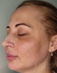 Результати Facetem S 1.5ml *1 шт. + конектор  фото после #2