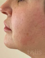 Результаты Набор TESSLIFT SOFT V-DERM (10 нитей) + Бандаж + канюля SoftFil 18G 90mm + 18G*40mm игла  фото до #1