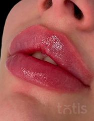 Результати Saypha Filler Lidocaine NEW  фото после #2