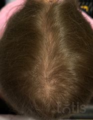 Результати Plinest Hair  фото после #2