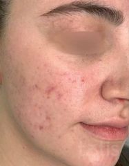 Результаты Rosacea Relief NEW  фото после #2