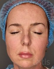 Rezultate Facetem S 0.8ml * 1 seringă  фото после #2