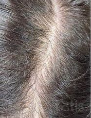 Результати Plinest Hair  фото до #1