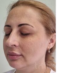 Результати Facetem S 1,5 ml  фото до #1