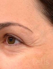Результаты ULTIMATE EYE CORRECTOR  фото до #1