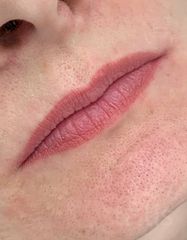 Результати Saypha Filler Lidocaine NEW  фото до #1