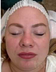Результаты Professional Peptide Perfection Exfoliator  фото до #1