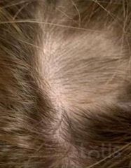 Результати Plinest Hair  фото после #2