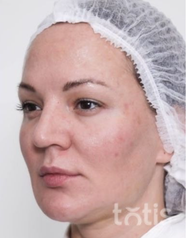 Rezultaty Zestaw TESSLIFT SOFT V-DERM (10 nici) + Bandaż + kaniula SoftFil 18G 70mm + igła 18G  фото до #1