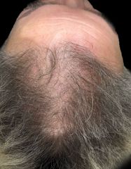 Результаты HAIR LOSS CONTROL  фото до #1
