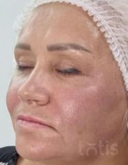 Результати Facetem S 1,5 ml  фото после #2