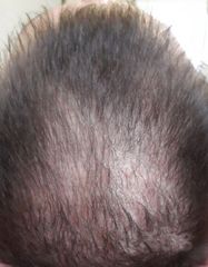 Rezultate Hair Restorer Xtra  фото до #1