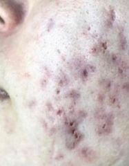 Rezultate SKIN RECOVERY  фото до #1