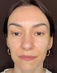 Výsledky Facetem S 0.8mlx2  фото до #1