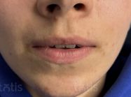 Результаты Saypha Filler Lidocaine NEW  фото до #1