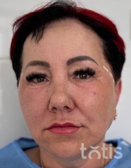 Rezultaty Zestaw TESSLIFT SOFT V-DERM (10 nici) + Bandaż + kaniula SoftFil 18G 70mm + igła 18G  фото после #2
