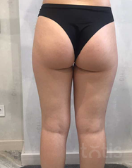 Результаты EPIGEN BODY CONTOUR  фото после #2