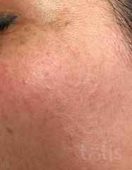Результаты Sensicura Regeneration Cream  фото до #1