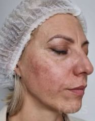 Rezultate Facetem S 0.8ml * 1 seringă  фото после #2