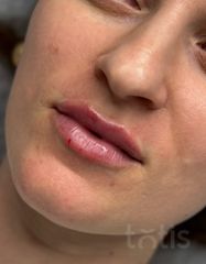 Результати Saypha lips Lidocaine  фото после #2