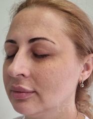 Результати Facetem S 1.5ml *1 шт. + конектор  фото до #1