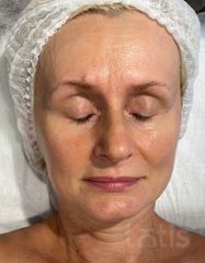 Результаты 650 Lift'Expert Wrinkle Smoother  фото до #1