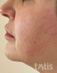 Rezultaty Zestaw TESSLIFT SOFT V-DERM (10 nici) + Bandaż + kaniula SoftFil 18G 70mm + igła 18G  фото до #1